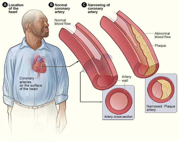 Read more about the article เส้นเลือดแดงกร่อน เมื่อความดันเลือดคงระดับสูง