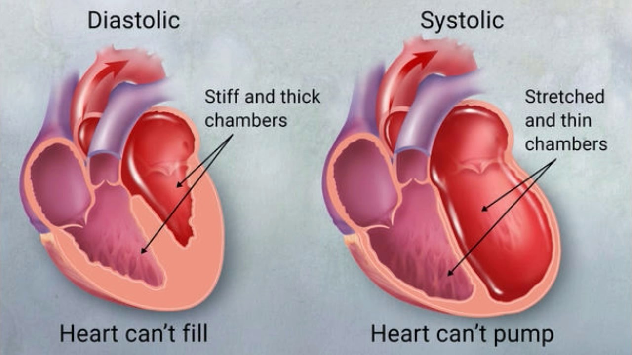 ภาวะหัวใจโต กับความดันโลหิตสูง – หัวใจกล้ามใหญ่ ..แต่กำลังหมดแรงปั้มเลือด